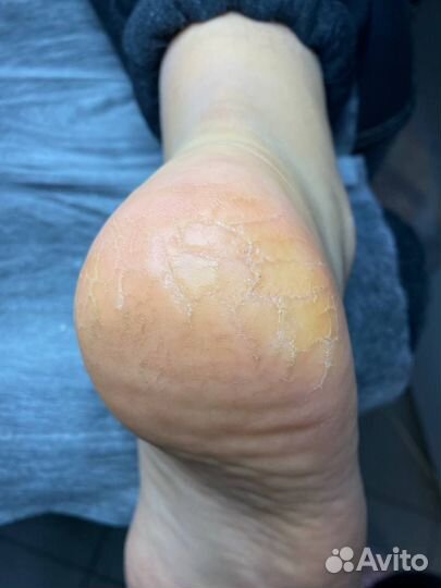 Сложный медицинский педикюр с выездом на дом