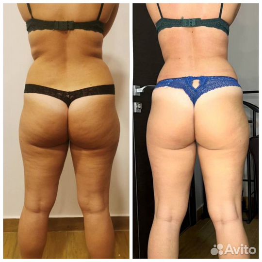 LPG массаж антицеллюлитный для похудения