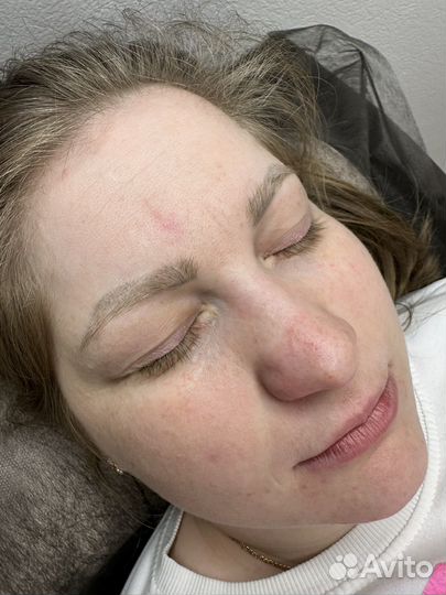 Удаление татуажа и тату лазером / ремувером