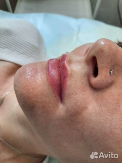 Контурная пластика губ