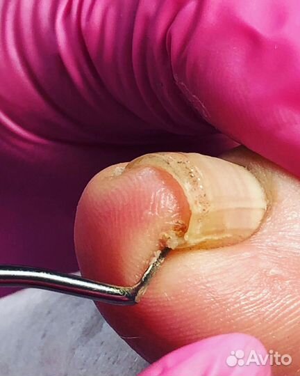 Установка титановой нити, зачистка онихолизиса