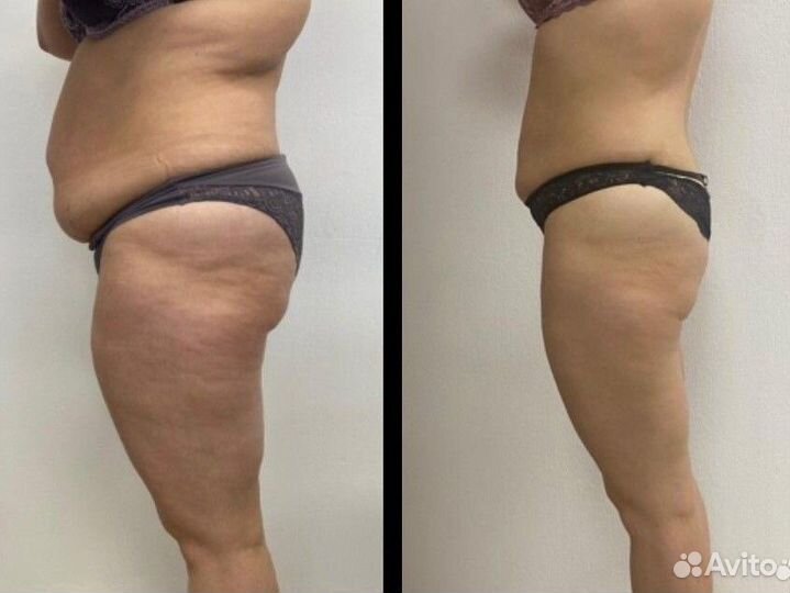 LPG массаж / Криолиполиз / Эпиляция