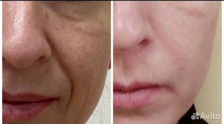 Косметолог/ Холодная плазма