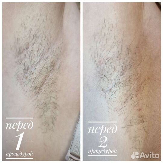 Электроэпиляция: глубокое бикини