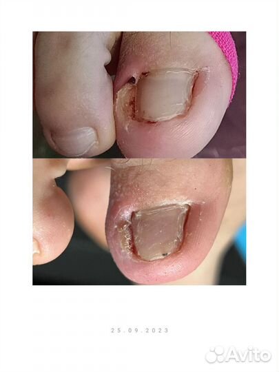 Удаление вросшего ногтя/титановая нить