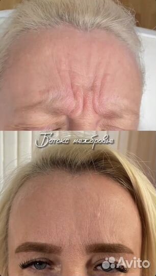 Ботокс для лица