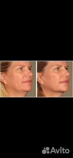 RF Лифтинг на современном аппарате