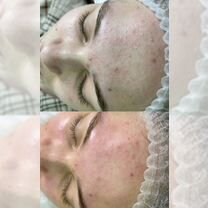 Чистка лица, Видное