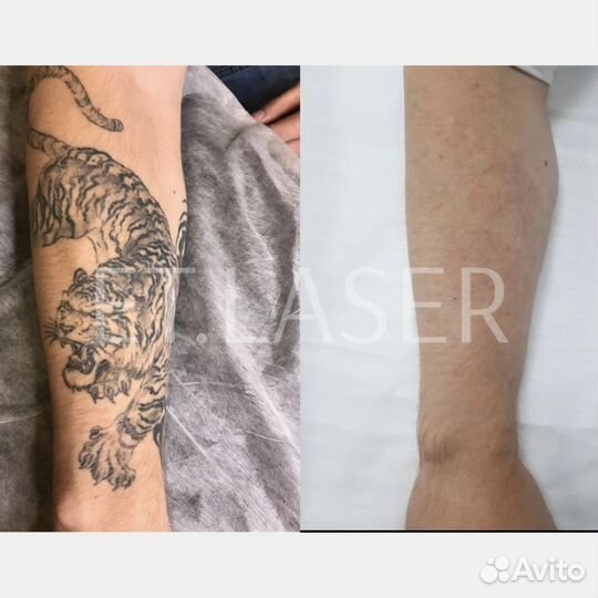 Удалить татуировку в Москве