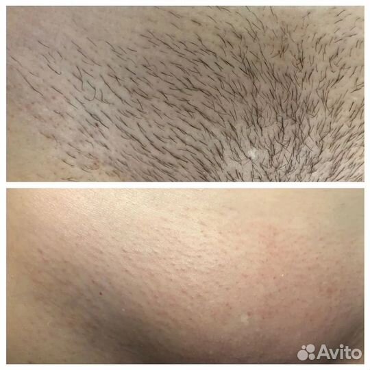 Восковая депиляция и шугаринг