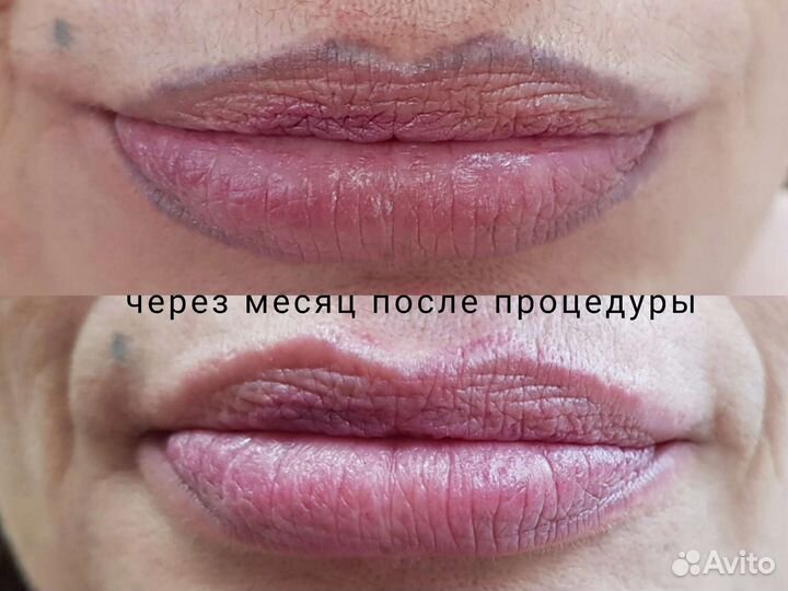 Удаление татуажа, микроблэйдинга