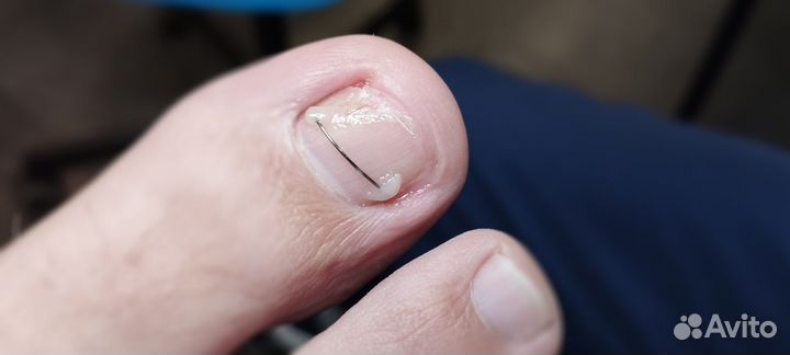 Установка титановой нити