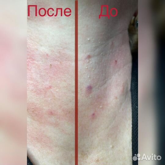 Удаление папиллом