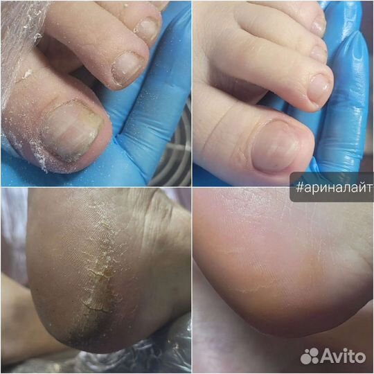 Сложный педикюр трещины вросший ноготь ищу модель