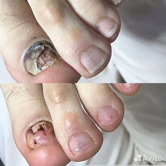Подолог. Медицинский педикюр