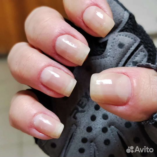 Реальное лечение грибка и вросших ногтей