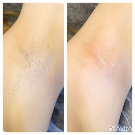 Шугаринг. Депиляция воском