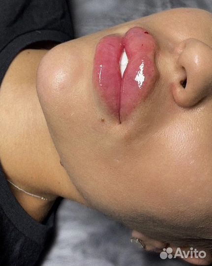 Косметолог, увеличение губ ботокс худое лицо, нити