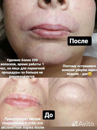 Электроэпиляция. Депиляция. ваксинг/шугаринг