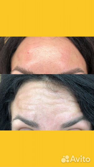 Ботокс для лица