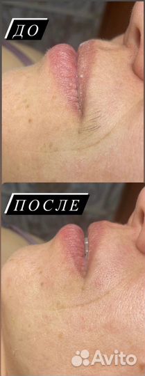 Восковая депиляция
