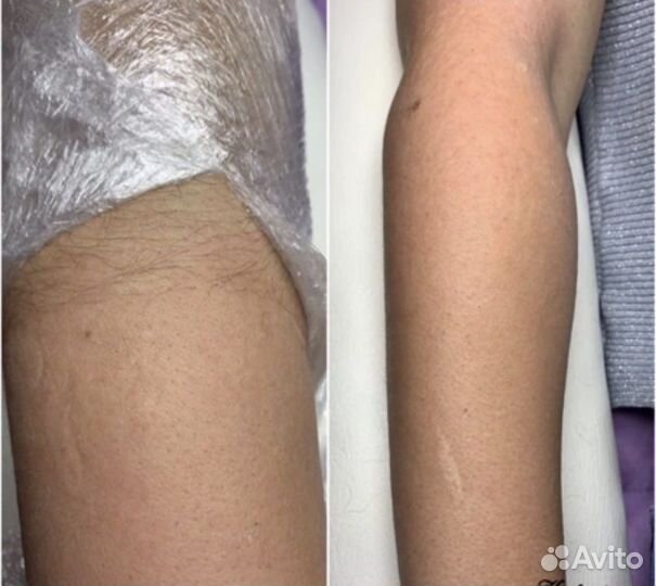 Электроэпиляция