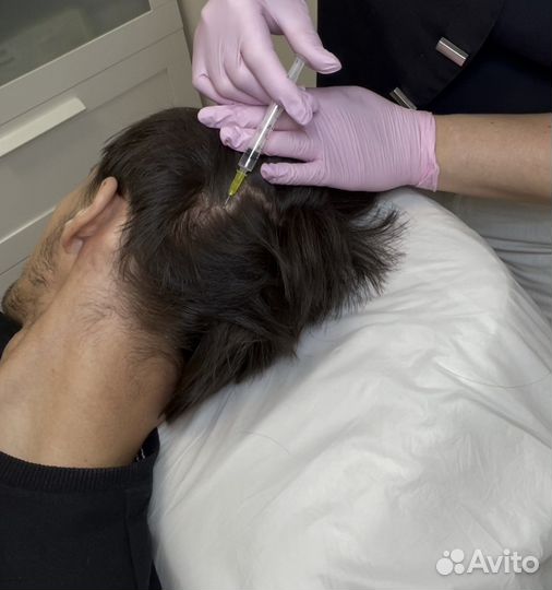 Мезотерапия волос