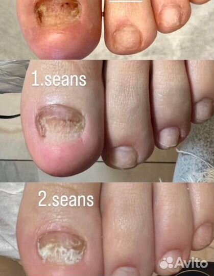 Косметолог/ Холодная плазма