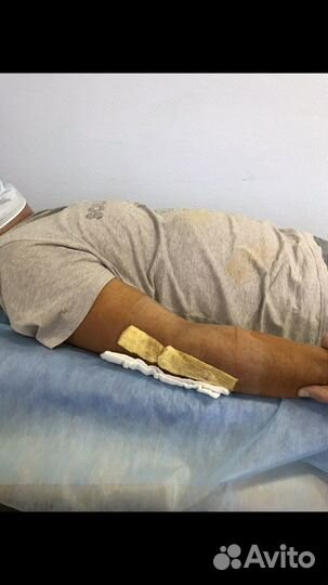 Реабилитация, Лфк, Аренда Миостимулятора(Compex)