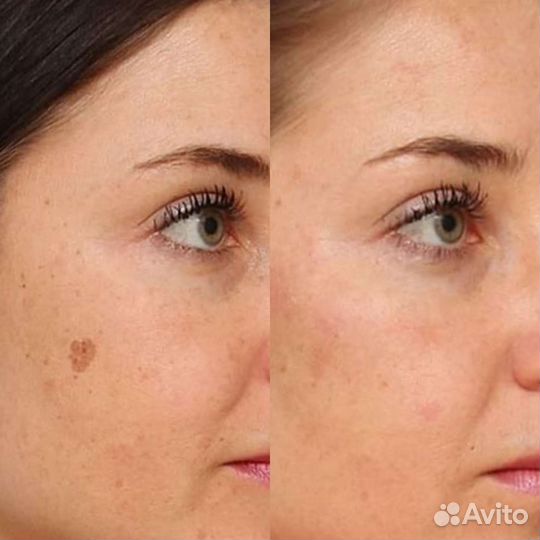 Удаление пигментных пятен, веснушек