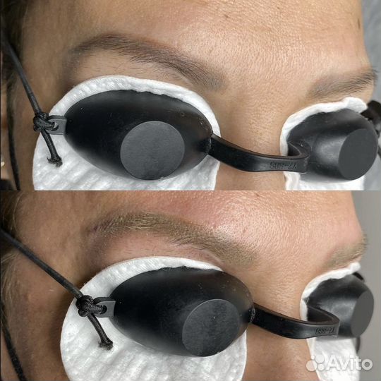 Удаление перманентного макияжа