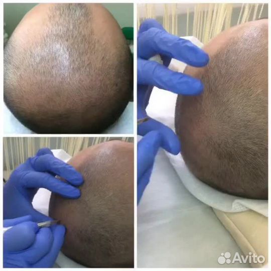 Обучение Трихопигментации