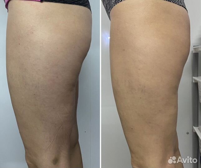 Аппаратная коррекция фигуры