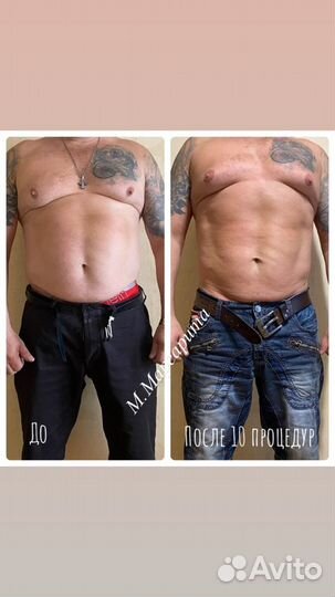 Антицеллюлитный массаж