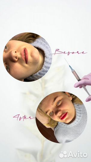 Увеличение губ / Выведение губ