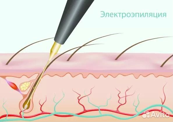 Электроэпиляция шугаринг