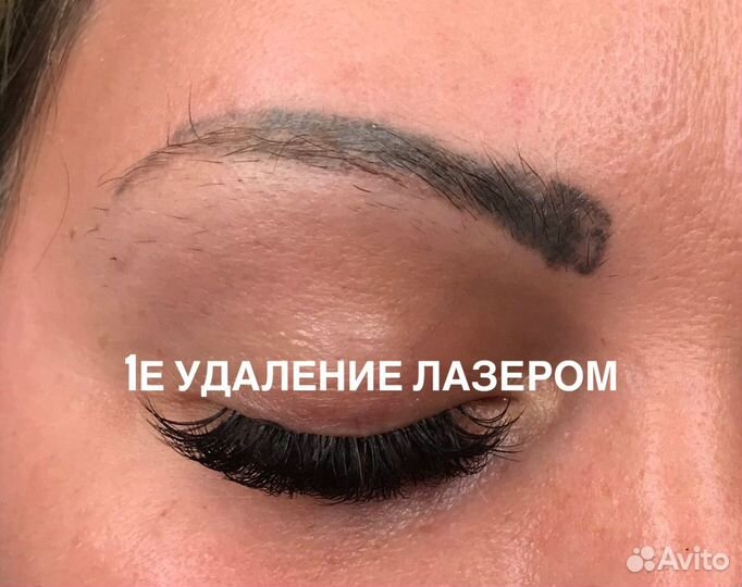 Удаление татуажа, перманентного макияжа, татуирово