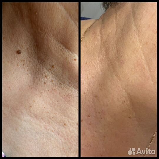 Удаление папиллом