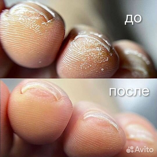 Смарт педикюр