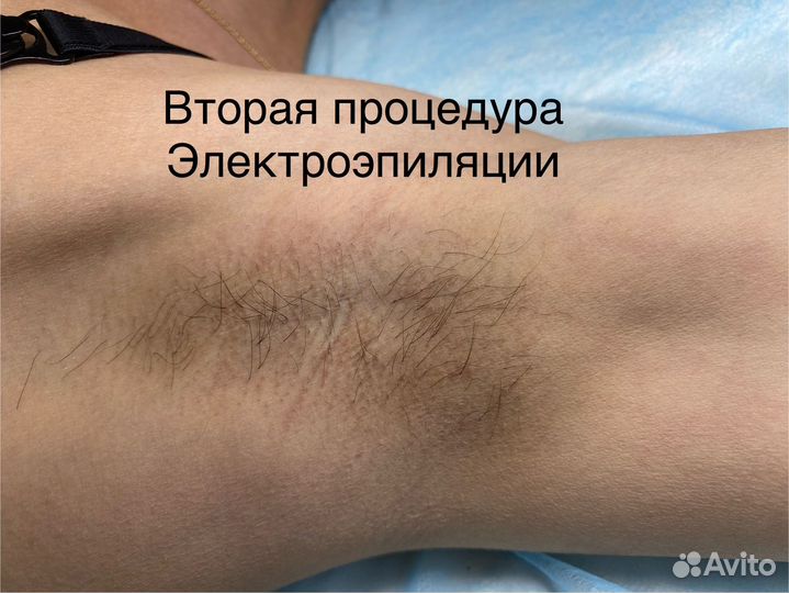 Электроэпиляция