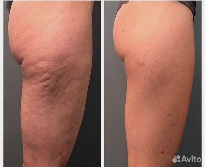 Коррекция фигуры, Вакуум, RF лифтинг, кавитация