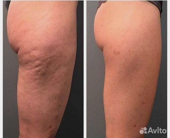 Коррекция фигуры, Вакуум, RF лифтинг, кавитация