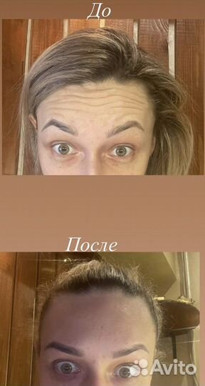 Мезотерапия волос