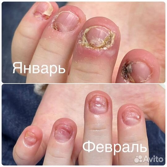 Маникюр,Подолог, мед педикюр, титановая нить