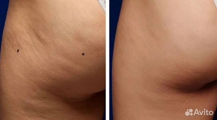 LPG (5 сеансов вакуумного массажа для позулкния)