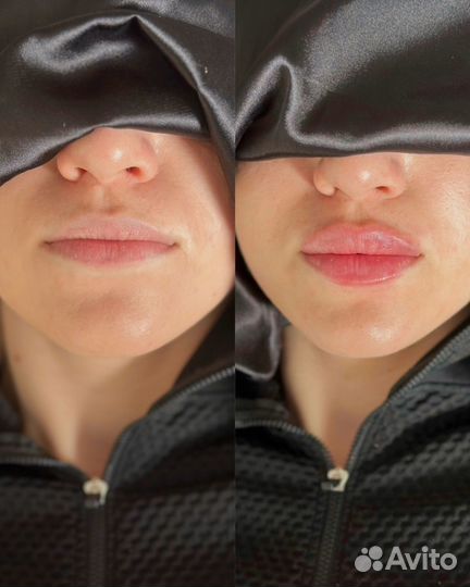 Увеличение губ