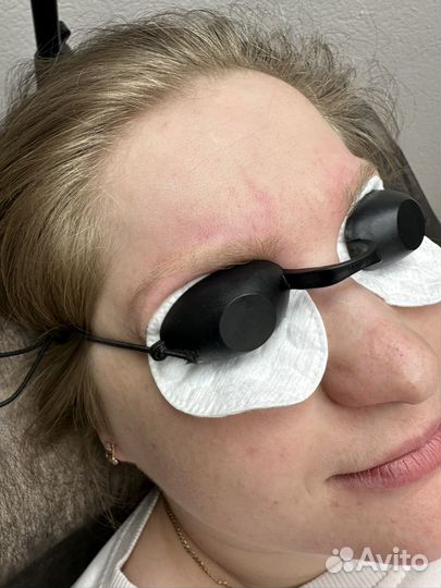 Удаление татуажа и тату лазером / ремувером