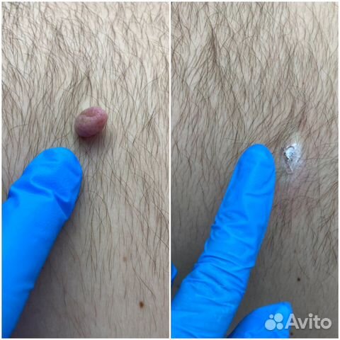 Удаление папилом, фибром, родинок