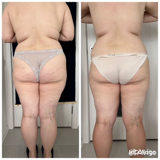 Антицеллюлитный массаж