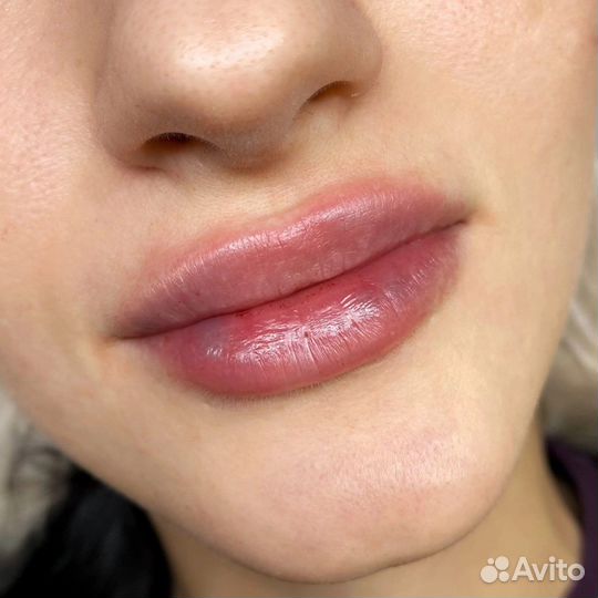 Увеличение губ